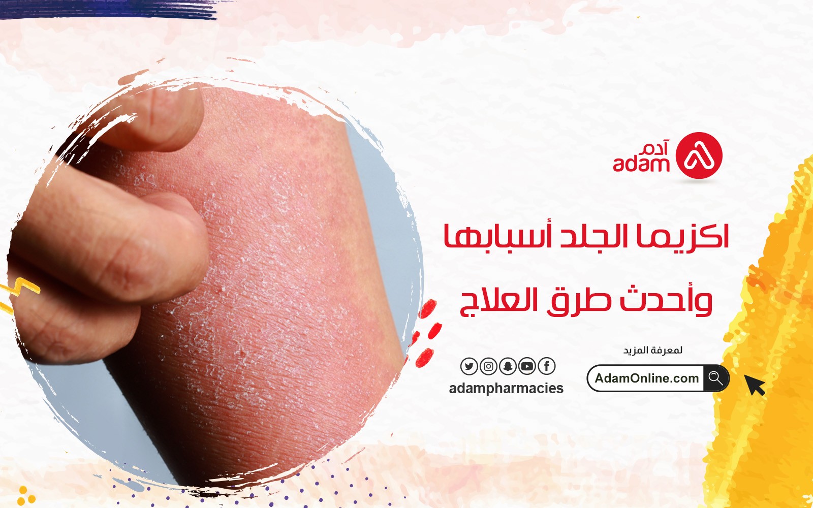 Eczema, its causes and the latest methods of treatment 