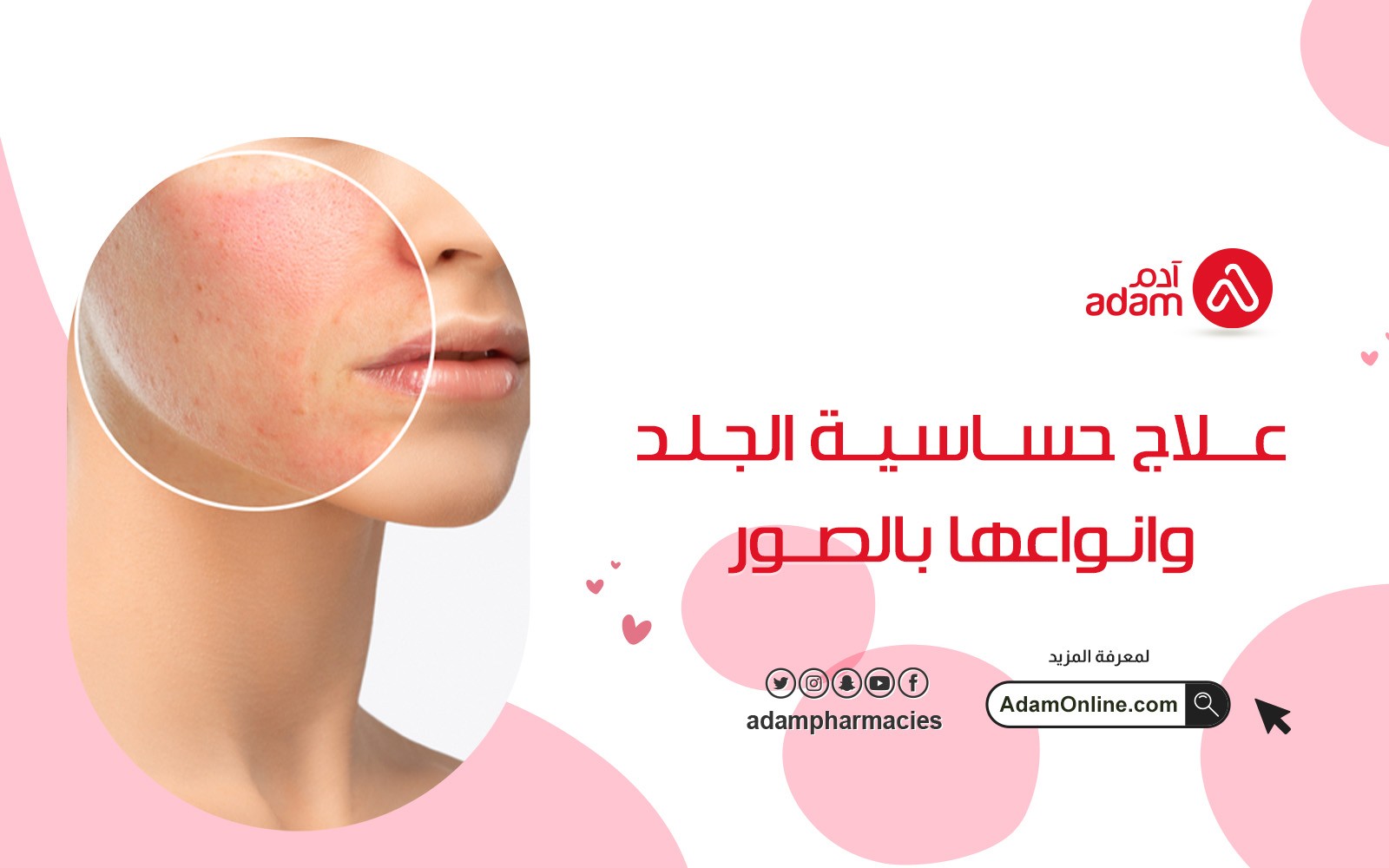 glutathione allergy rash Allergic Skin Caused by Iguratimod: A Report of Two Cases The best way to treat